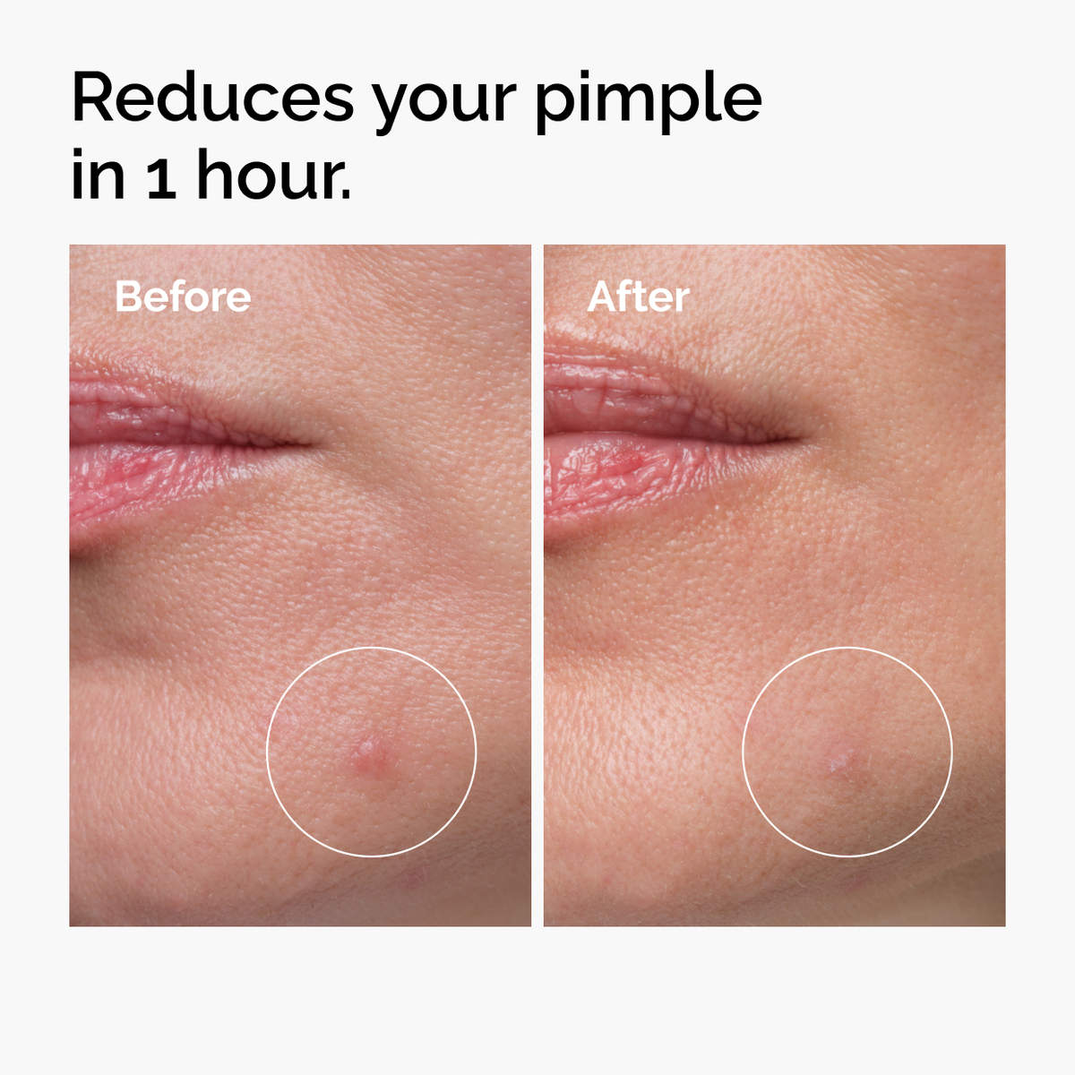 Before and after closeups showing a reduced pimple after one hour with circles highlighting the area.