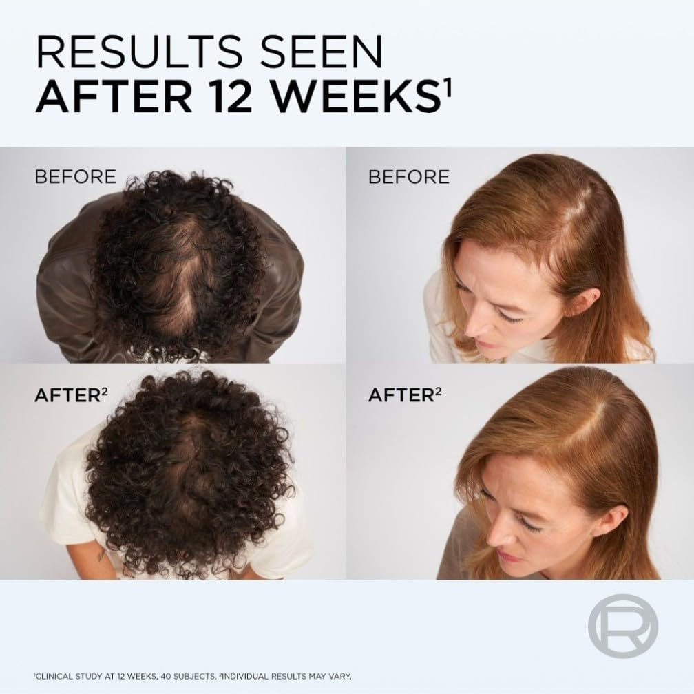 Before and after scalp comparison showing hair density improvement after 12 weeks of Elvive Growth Booster serum
